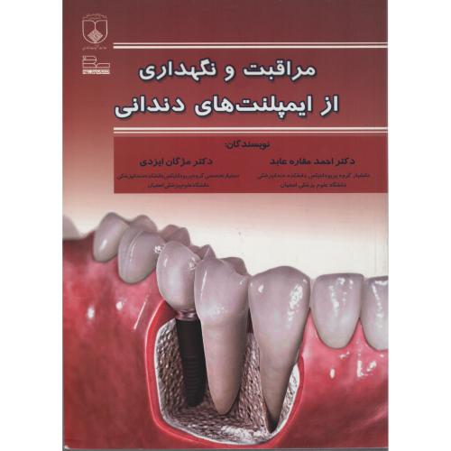 مراقبت و نگهداری از ایمپلنت های دندانی رویان پژوه